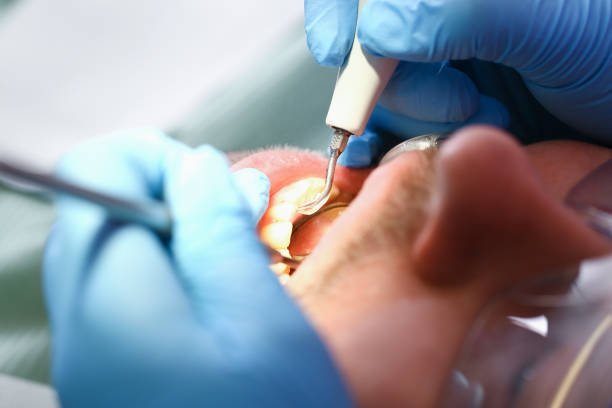 Best Emergency Tooth Extraction in Diberville, MS