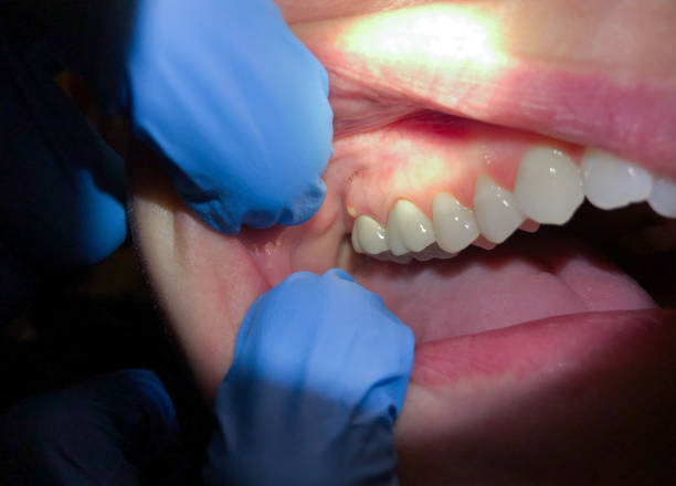 Best Emergency Gum Treatment in Diberville, MS