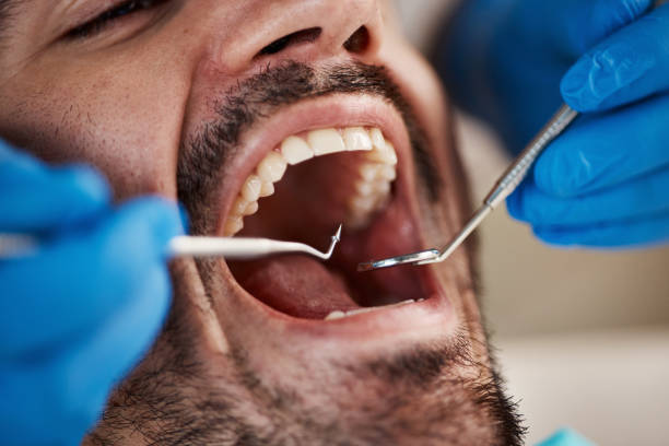 Best Emergency Treatment for Dental Infections or Abscesses in Diberville, MS