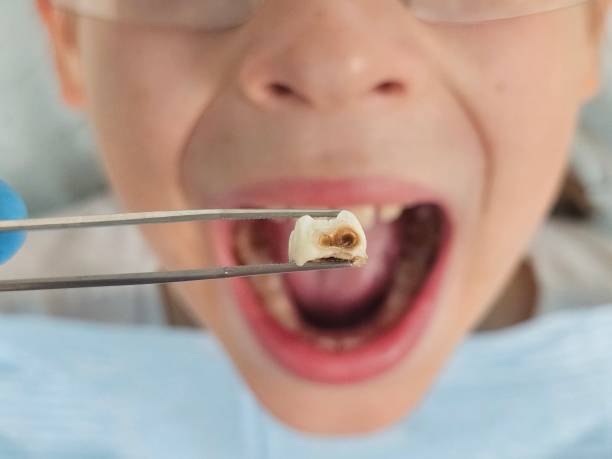 Best Emergency Dental Care for Broken or Chipped Teeth in Diberville, MS